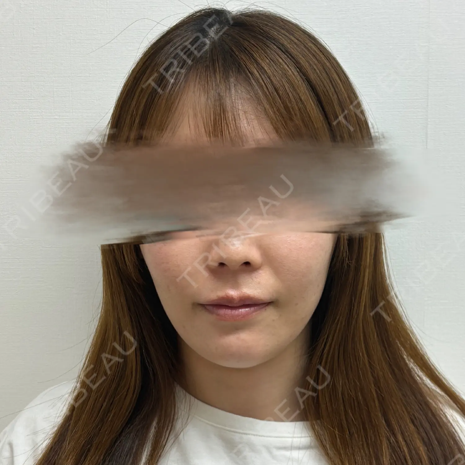 施術後の写真