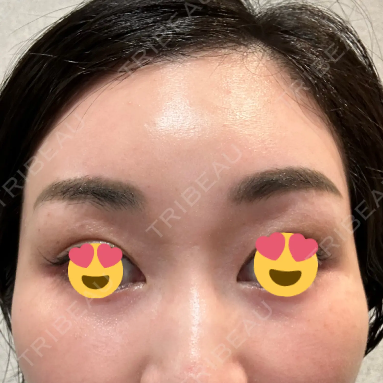 施術後の写真