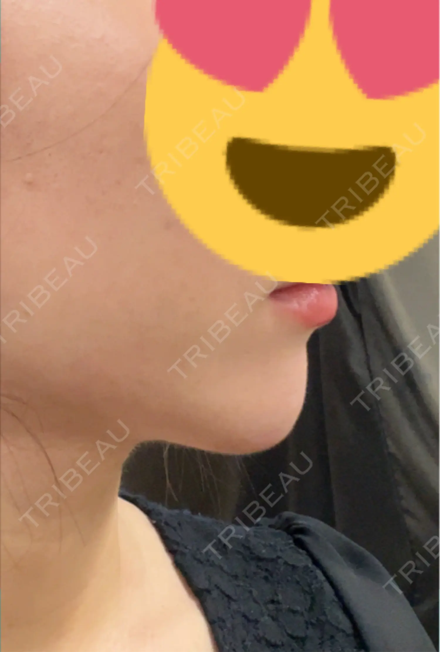 施術後の写真