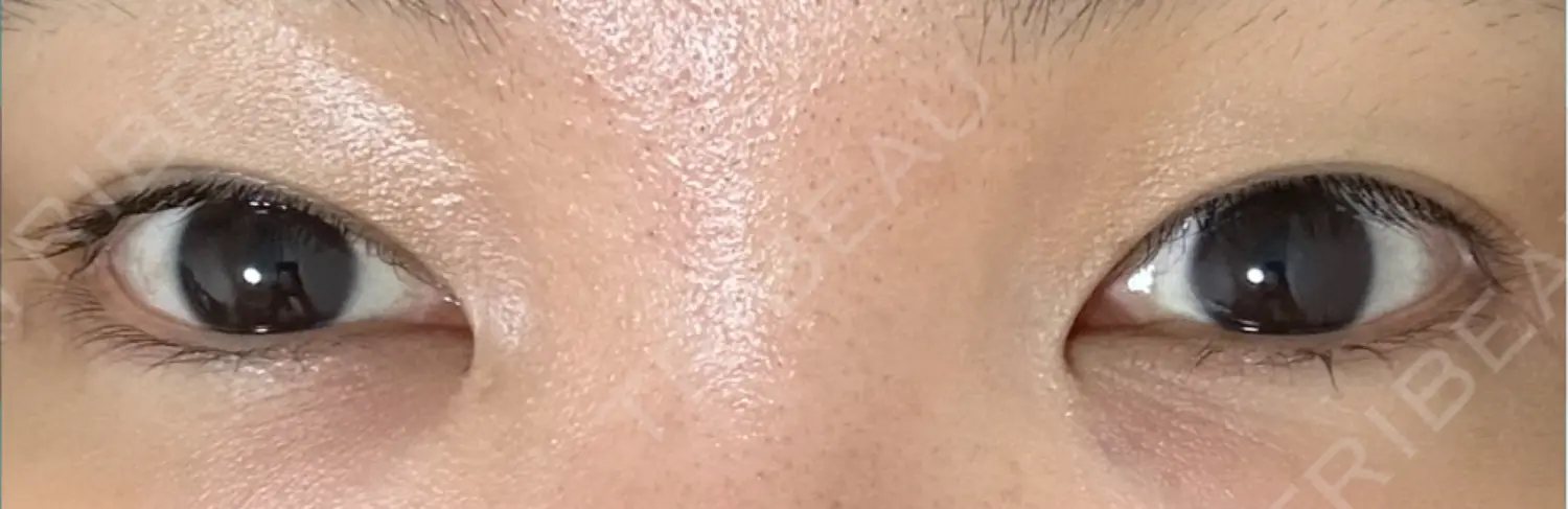 施術後の写真