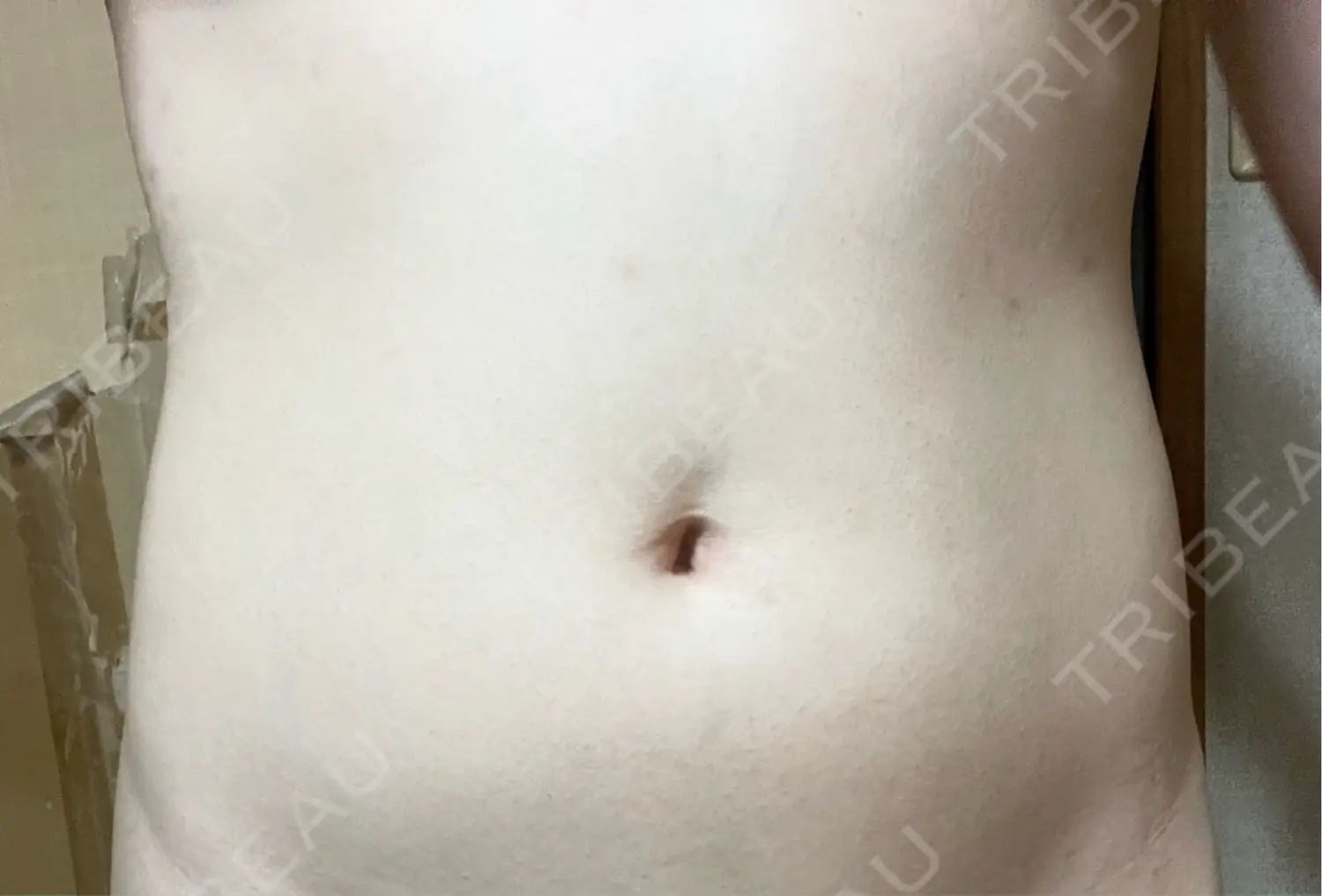 施術後の写真