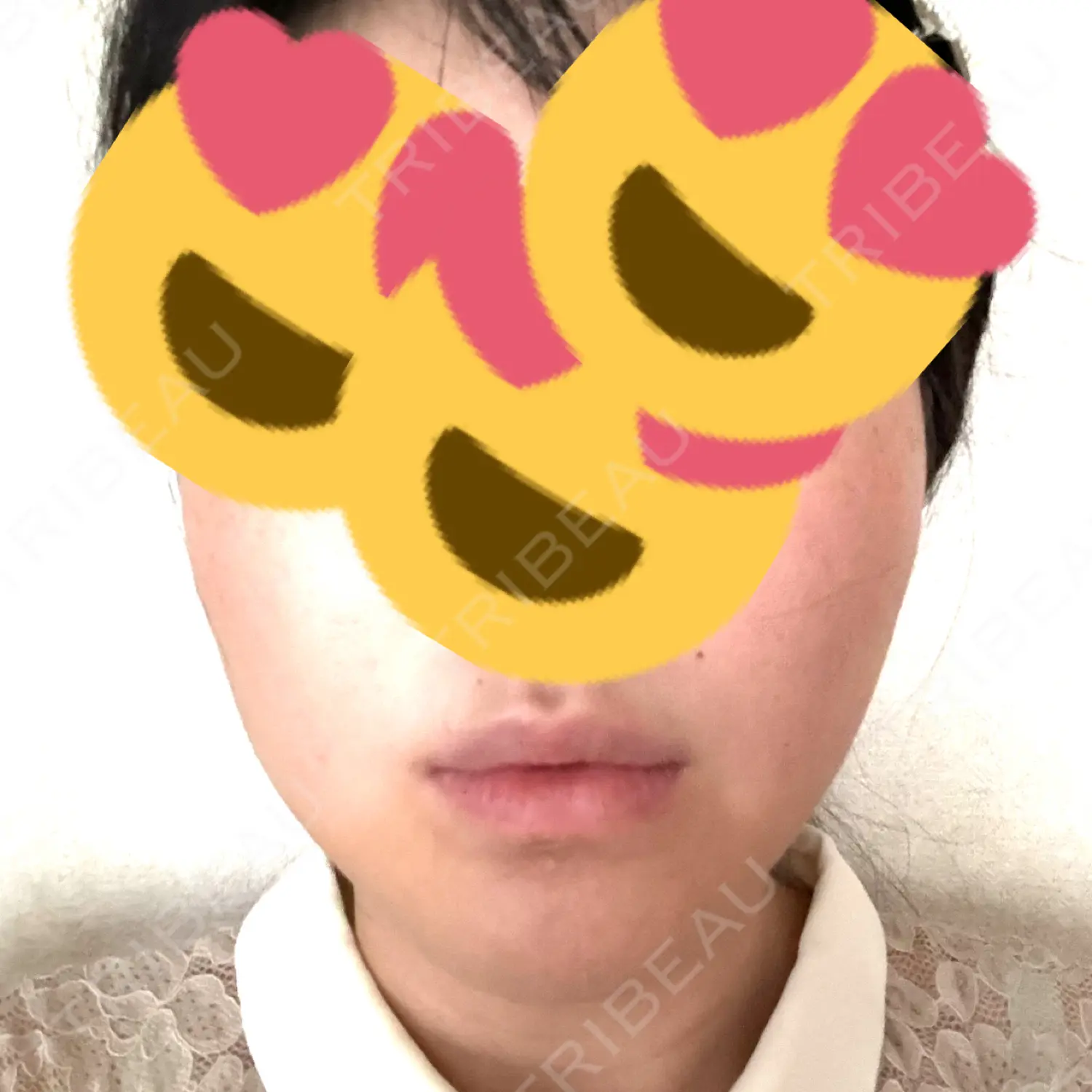 施術後の写真