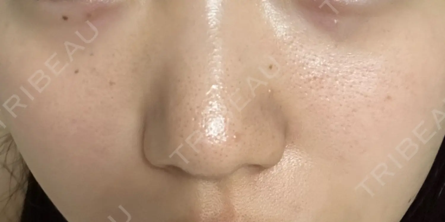 施術後の写真