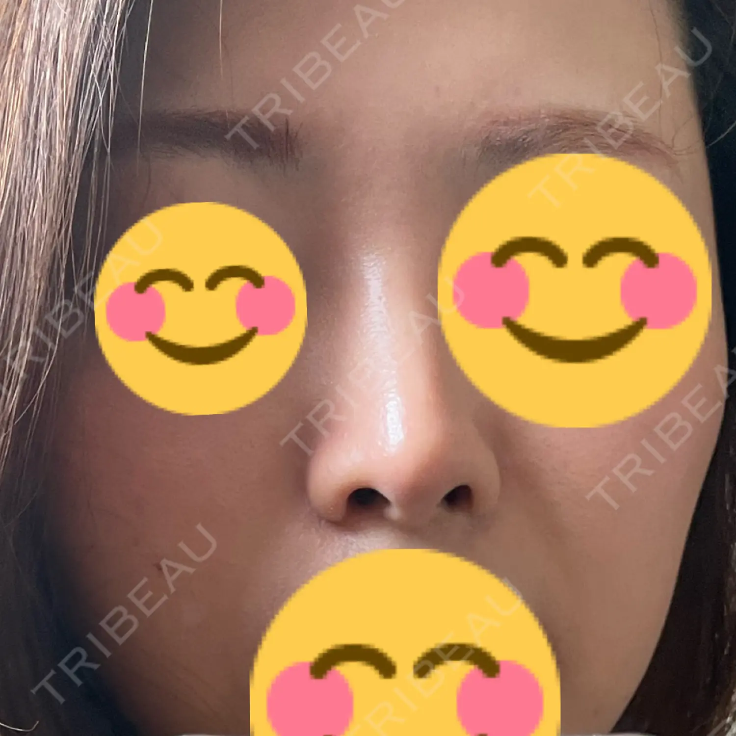 施術後の写真