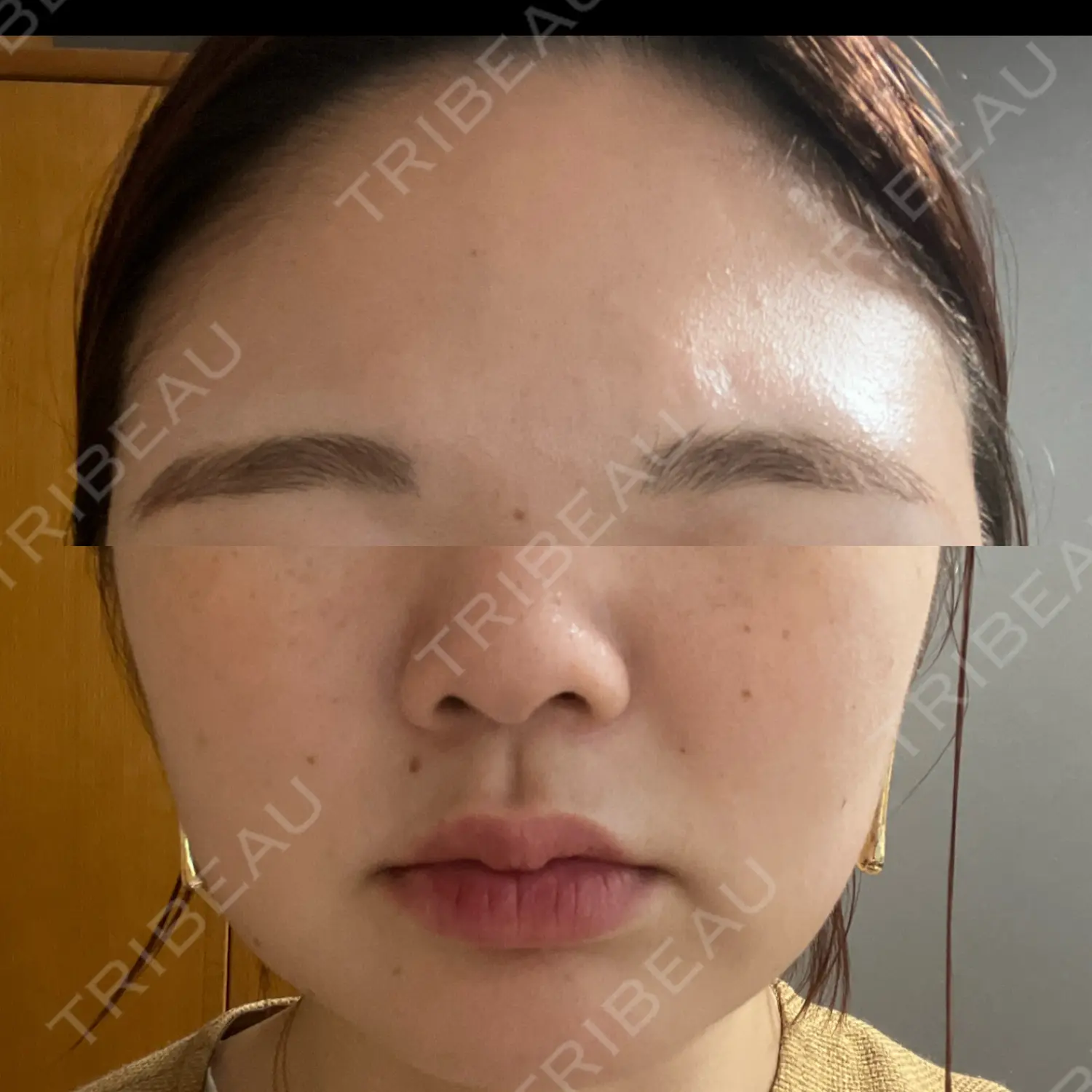 施術後の写真