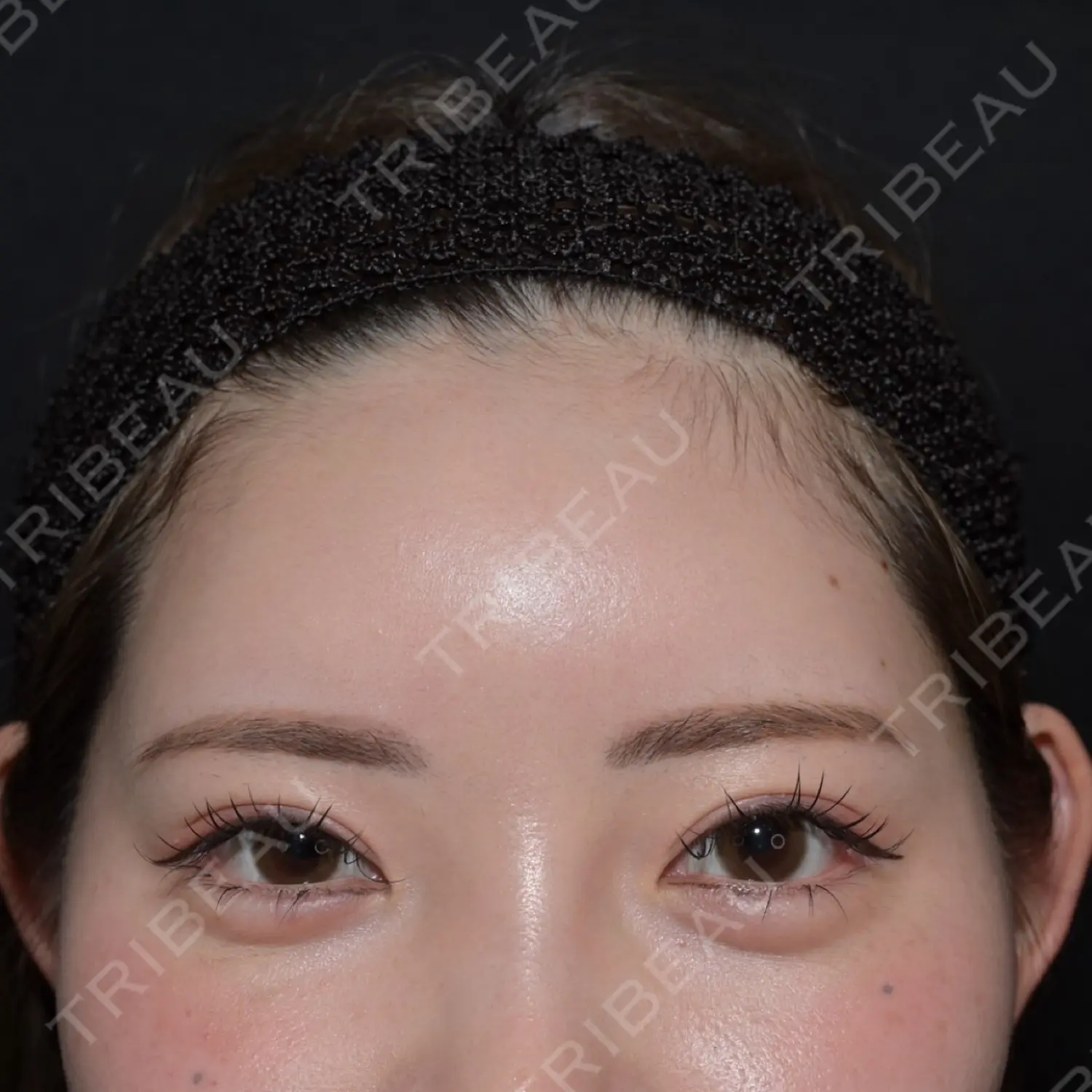 施術後の写真
