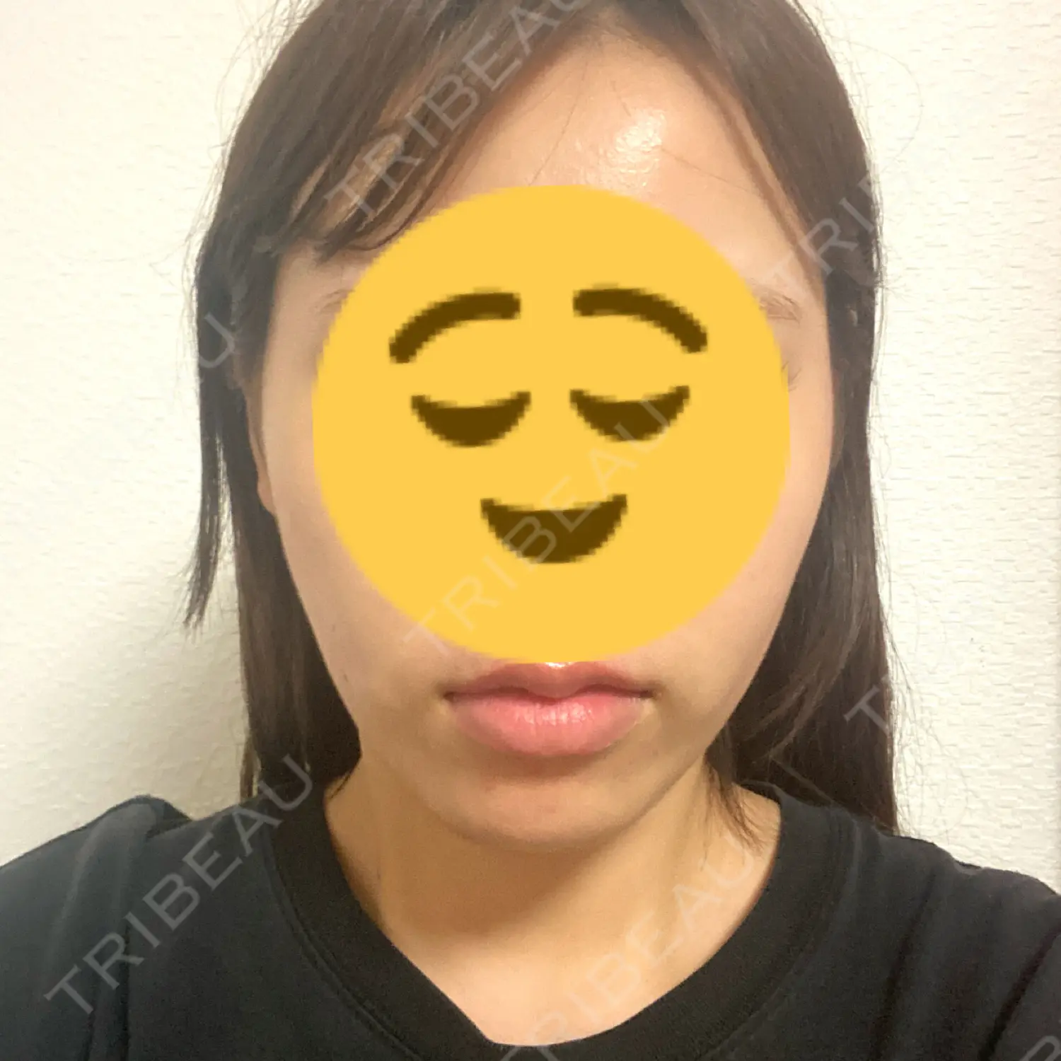 施術後の写真