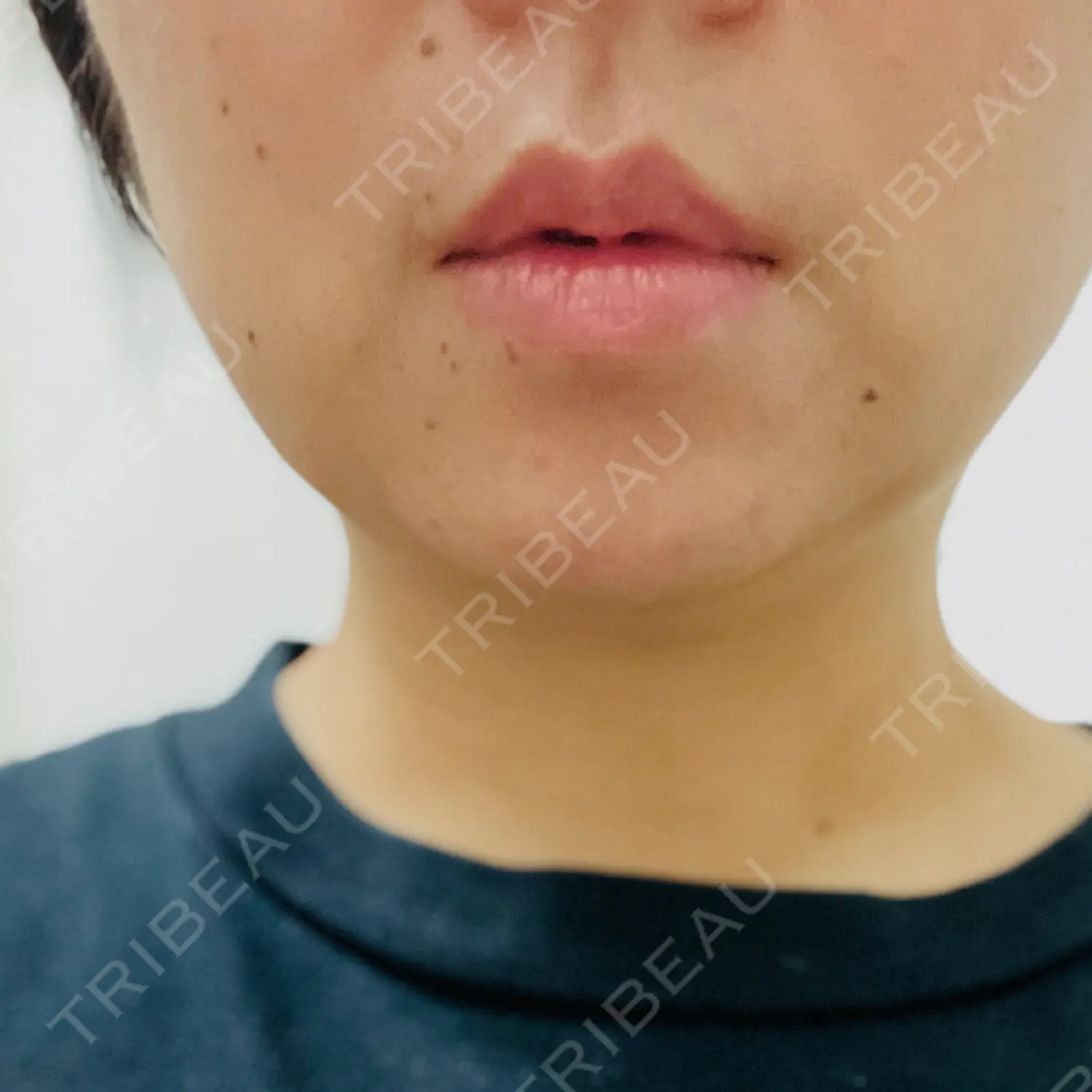 施術後の写真