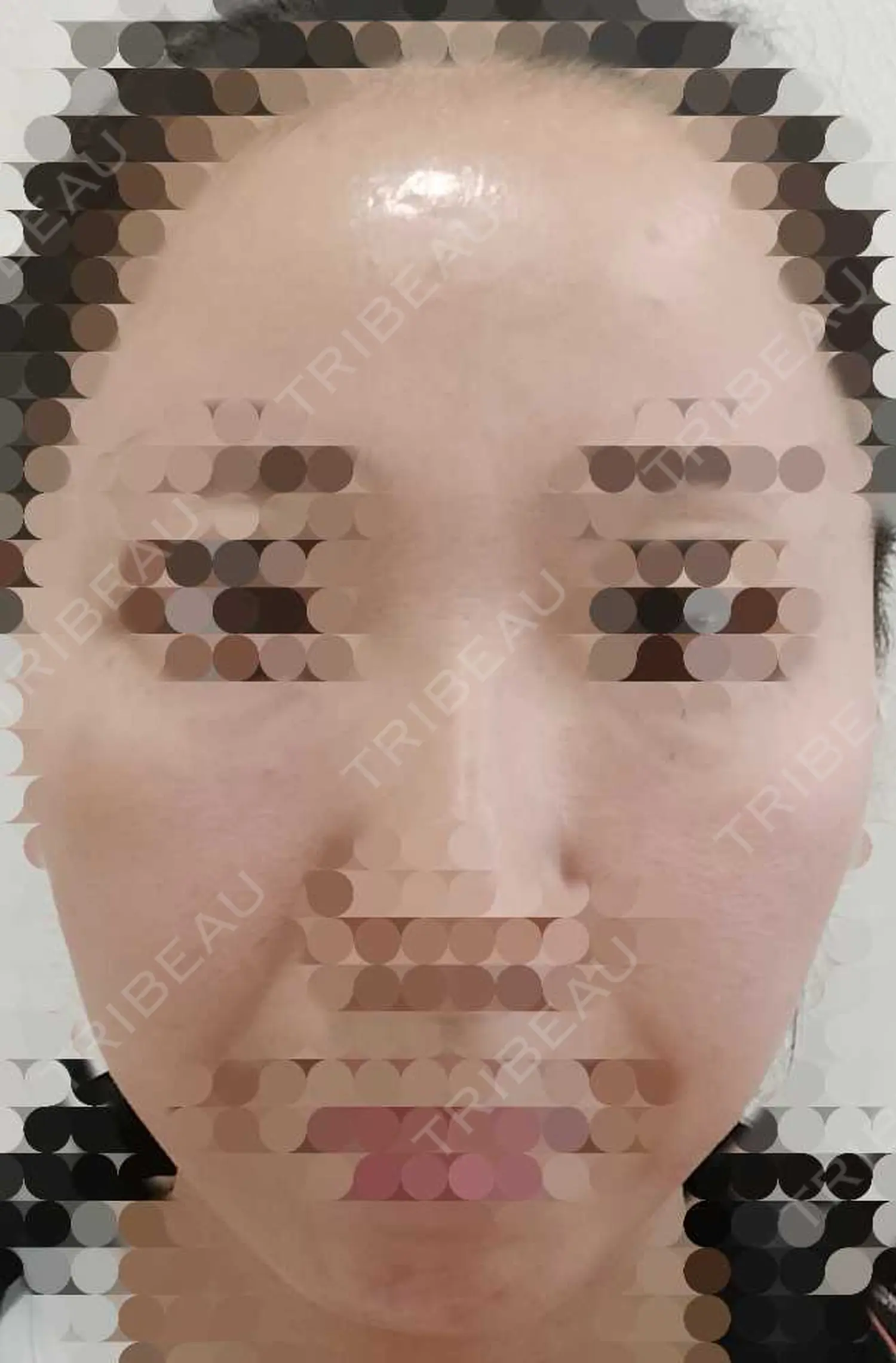 施術後の写真