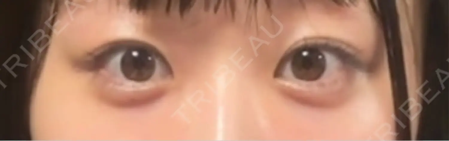 施術後の写真