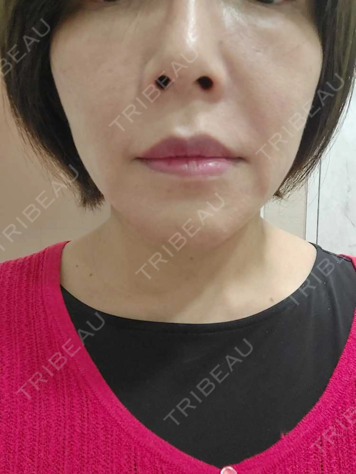 施術後の写真