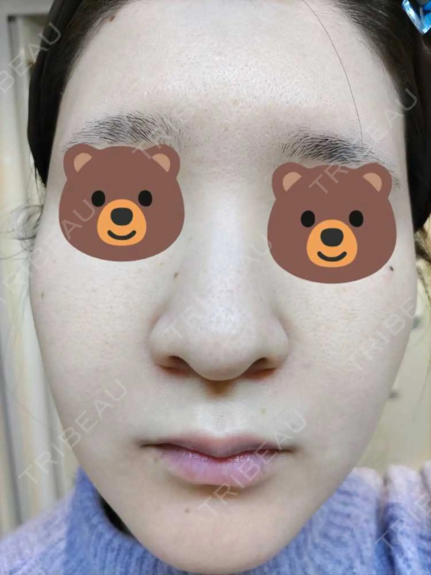 施術後の写真