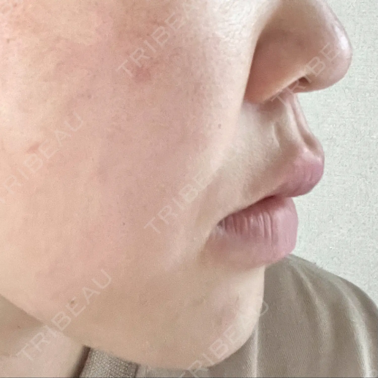 施術後の写真