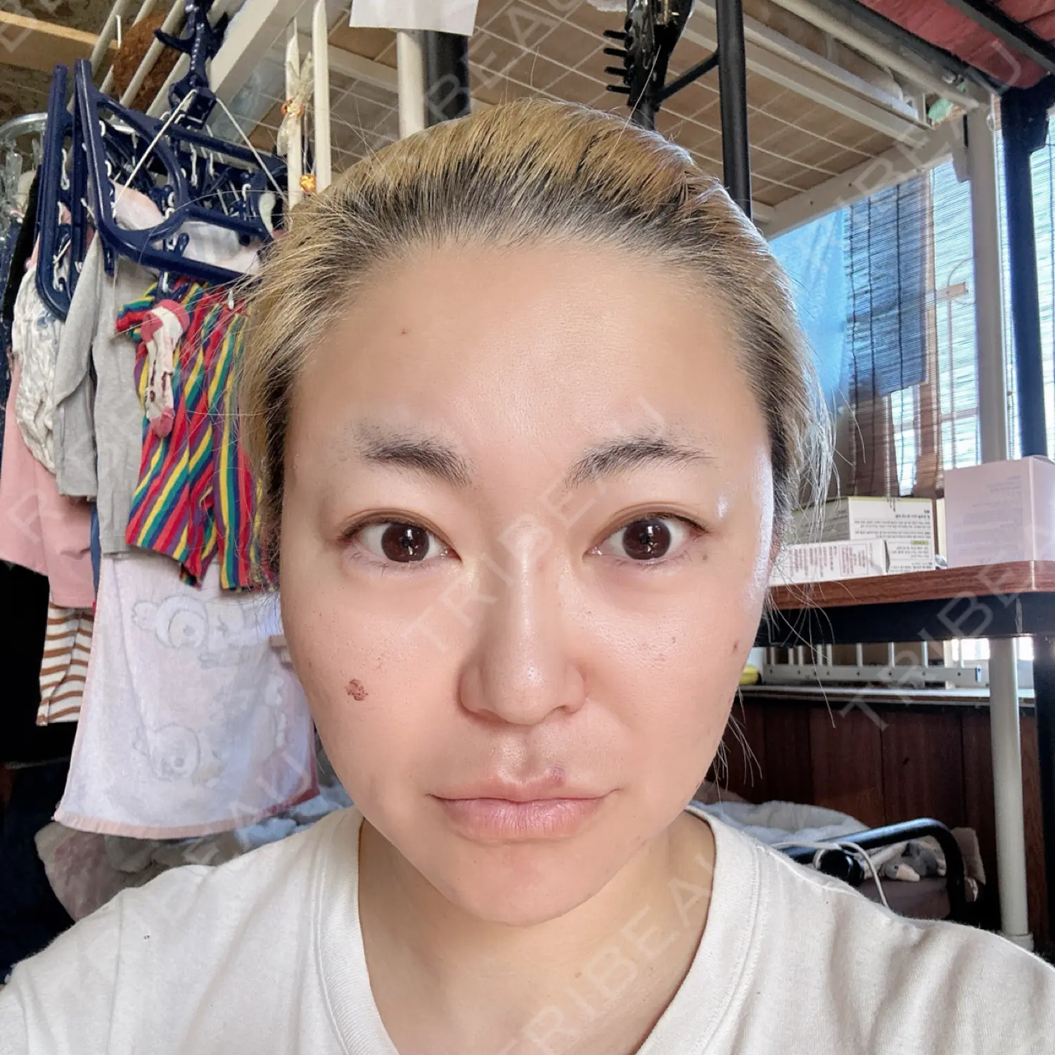 施術後の写真