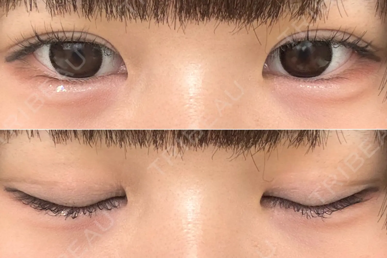 施術後の写真