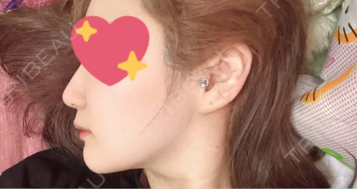 施術後の写真