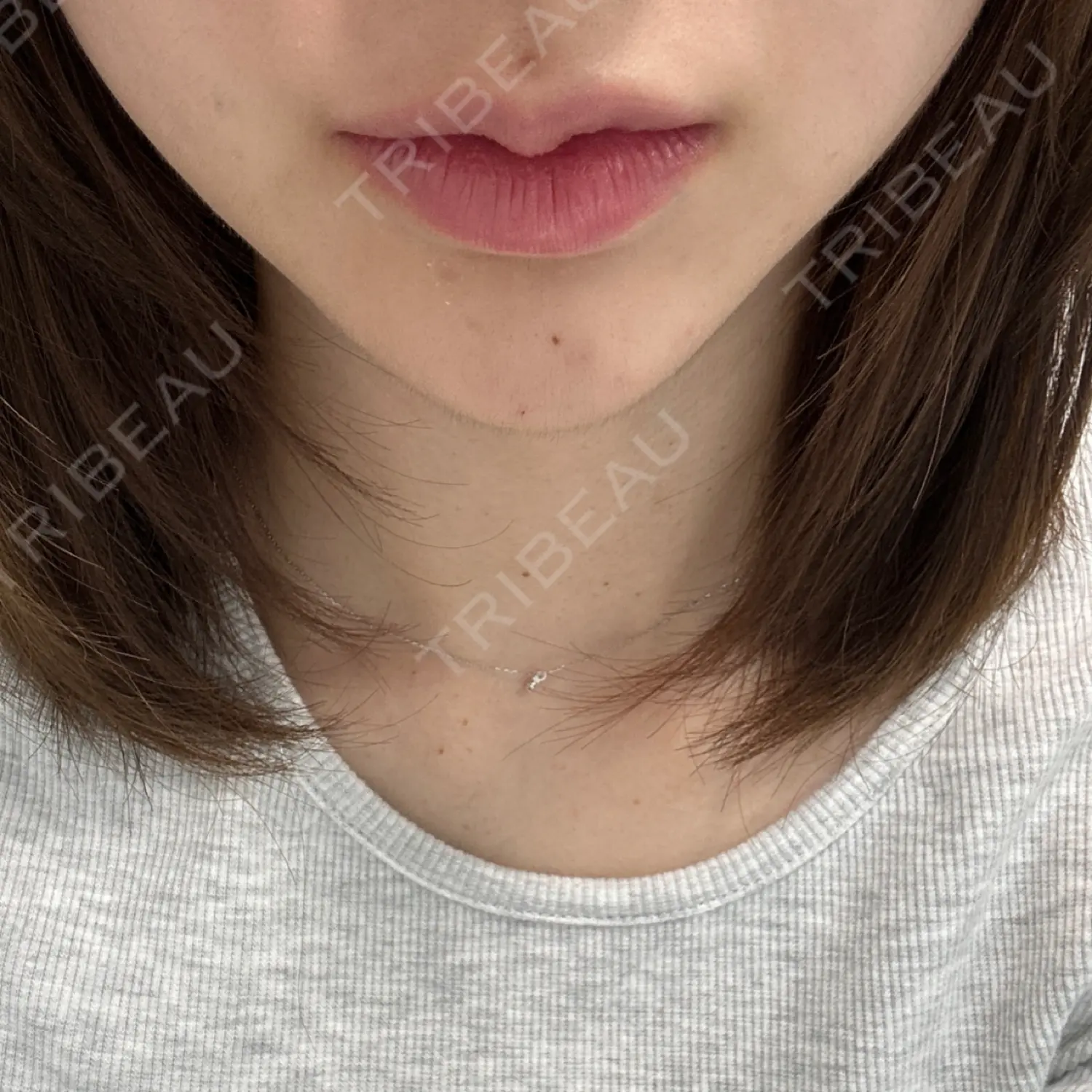 施術後の写真