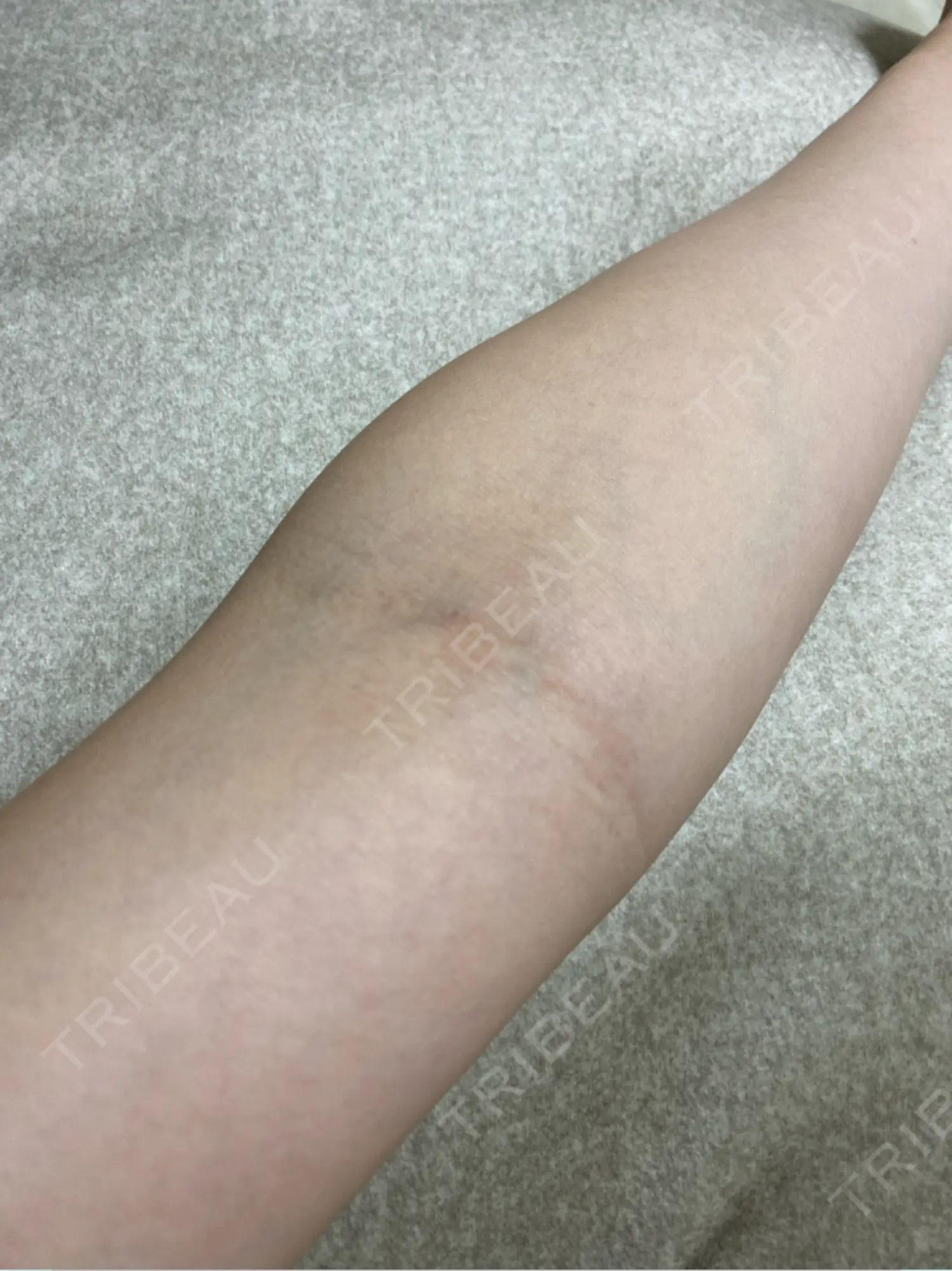 施術後の写真