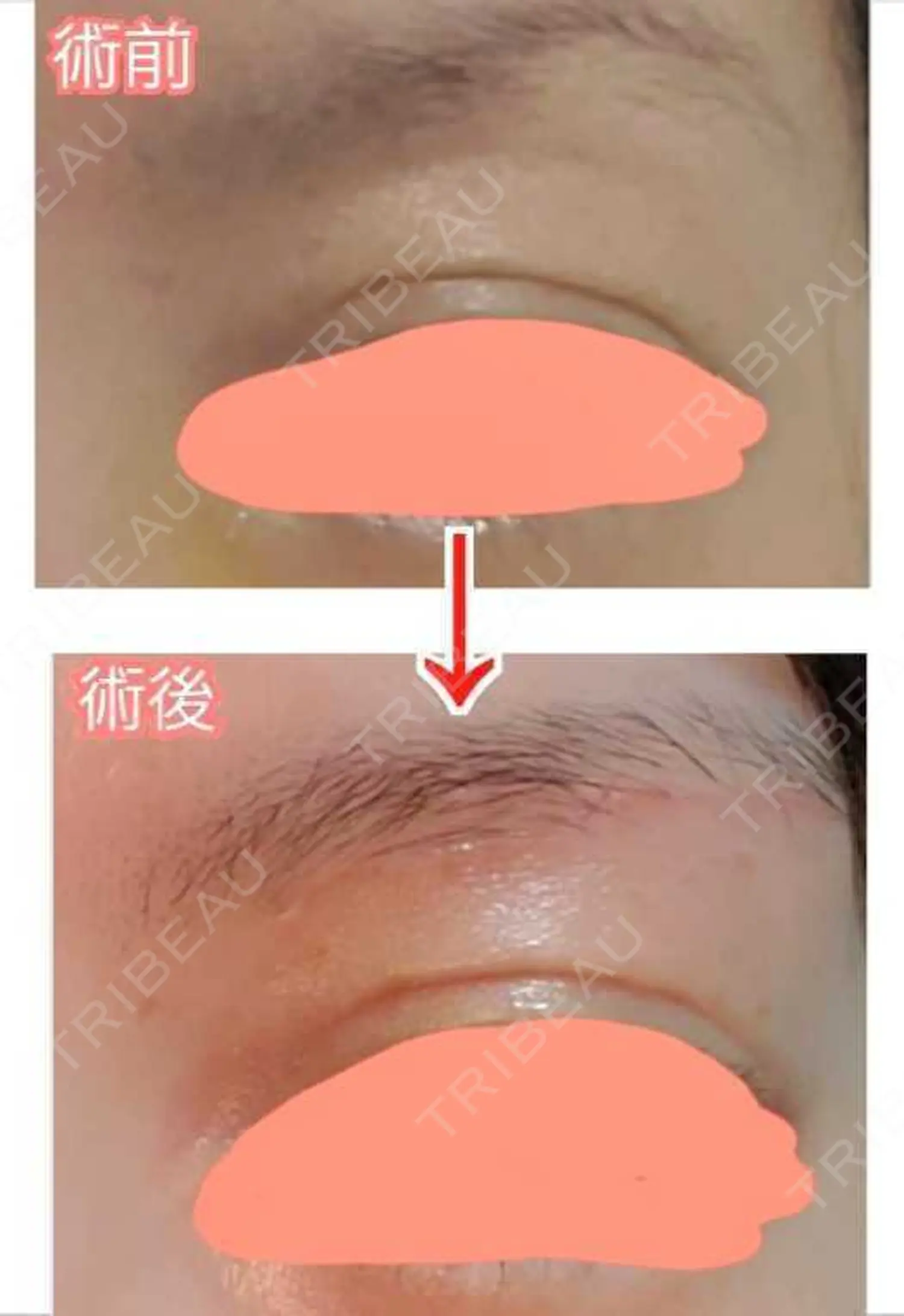 施術後の写真