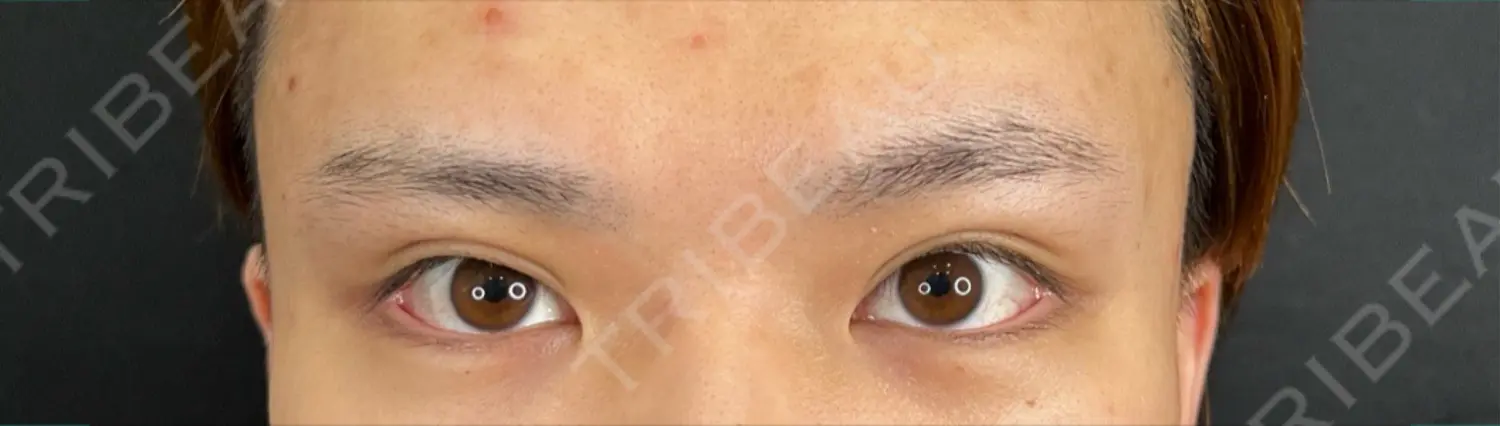 施術後の写真