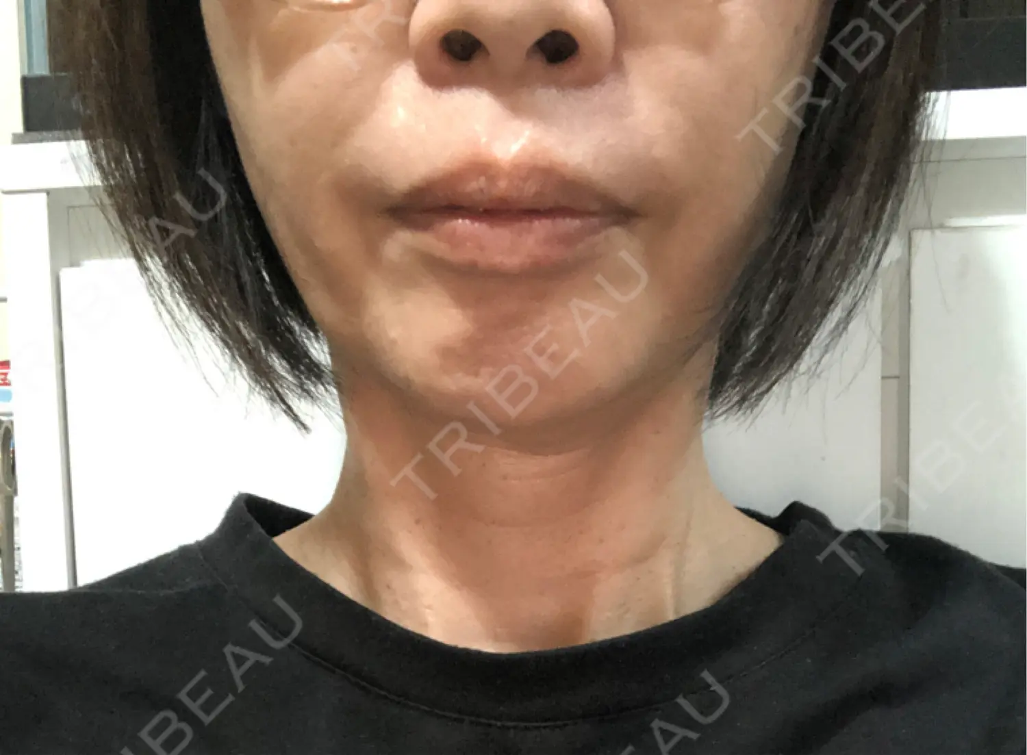 施術後の写真
