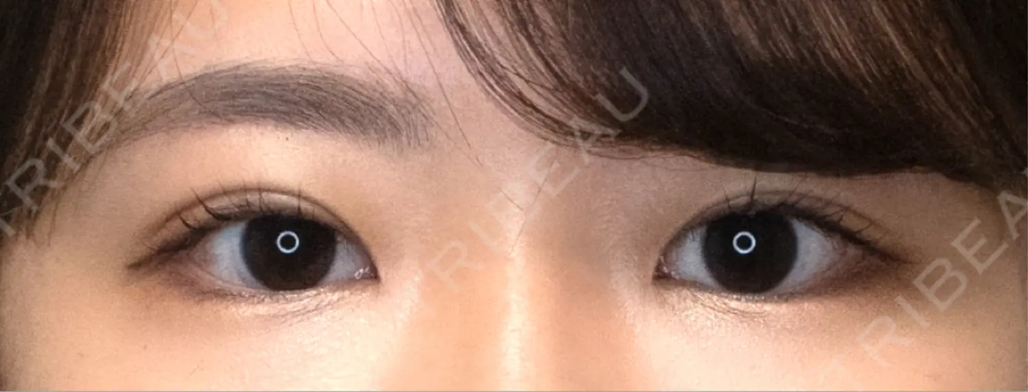 施術後の写真