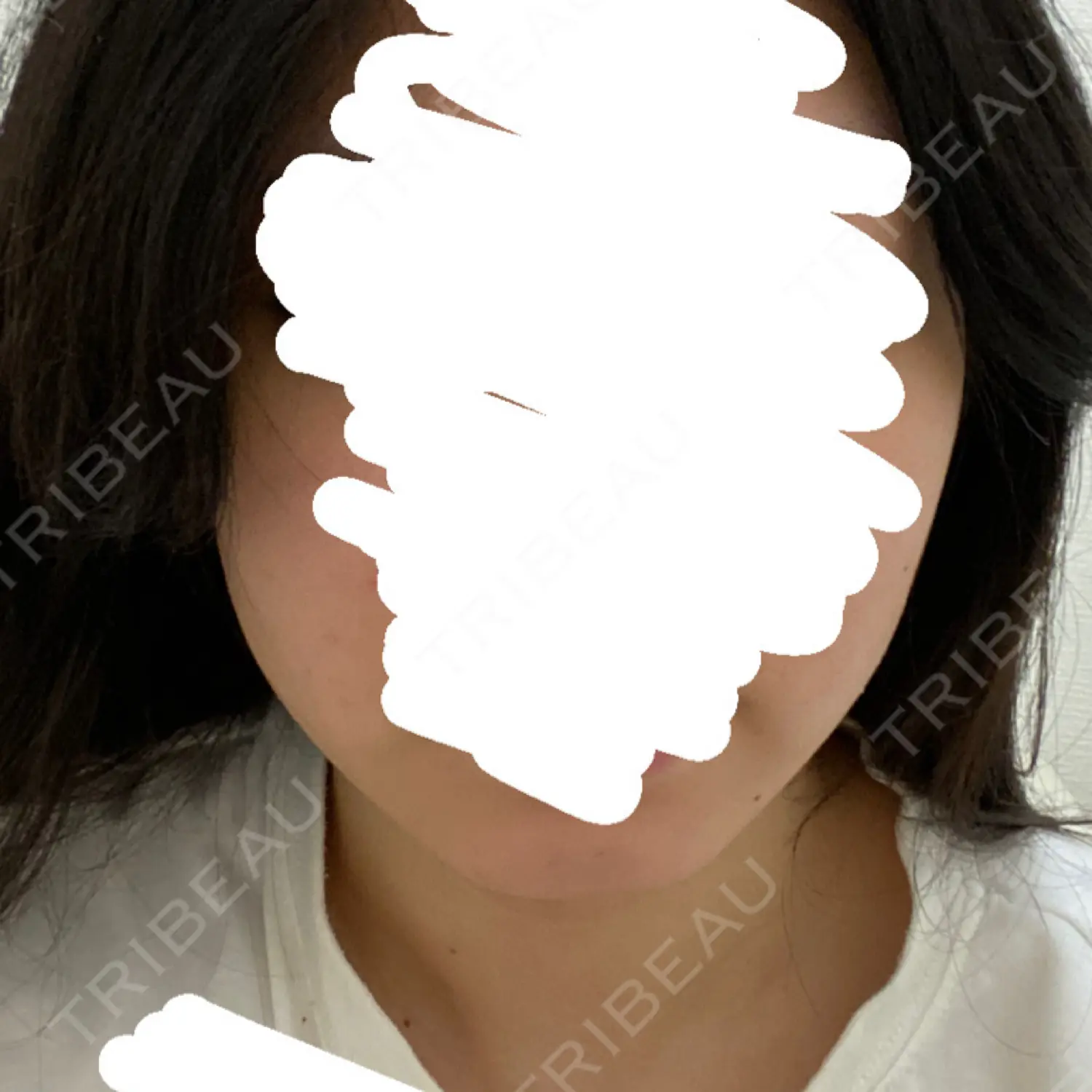 施術後の写真