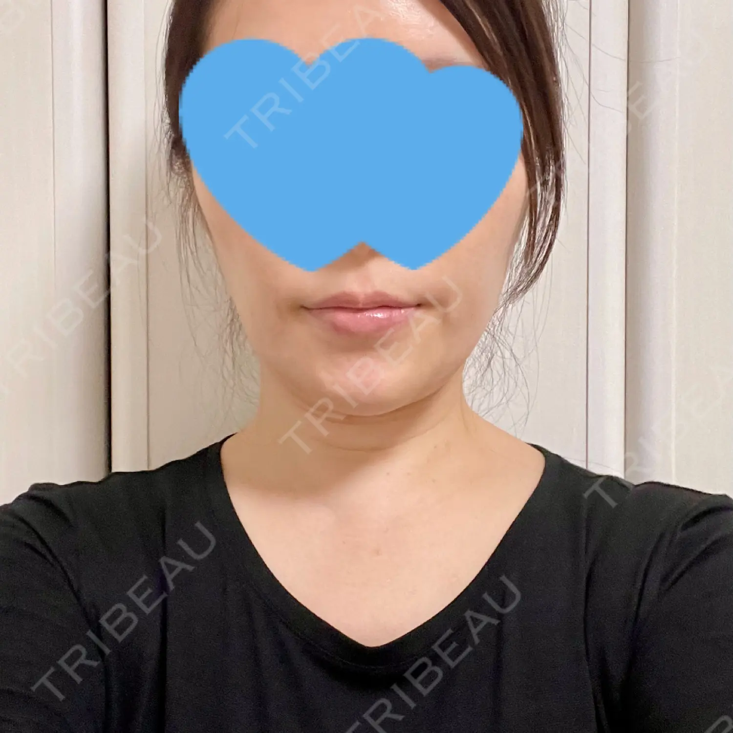 施術後の写真