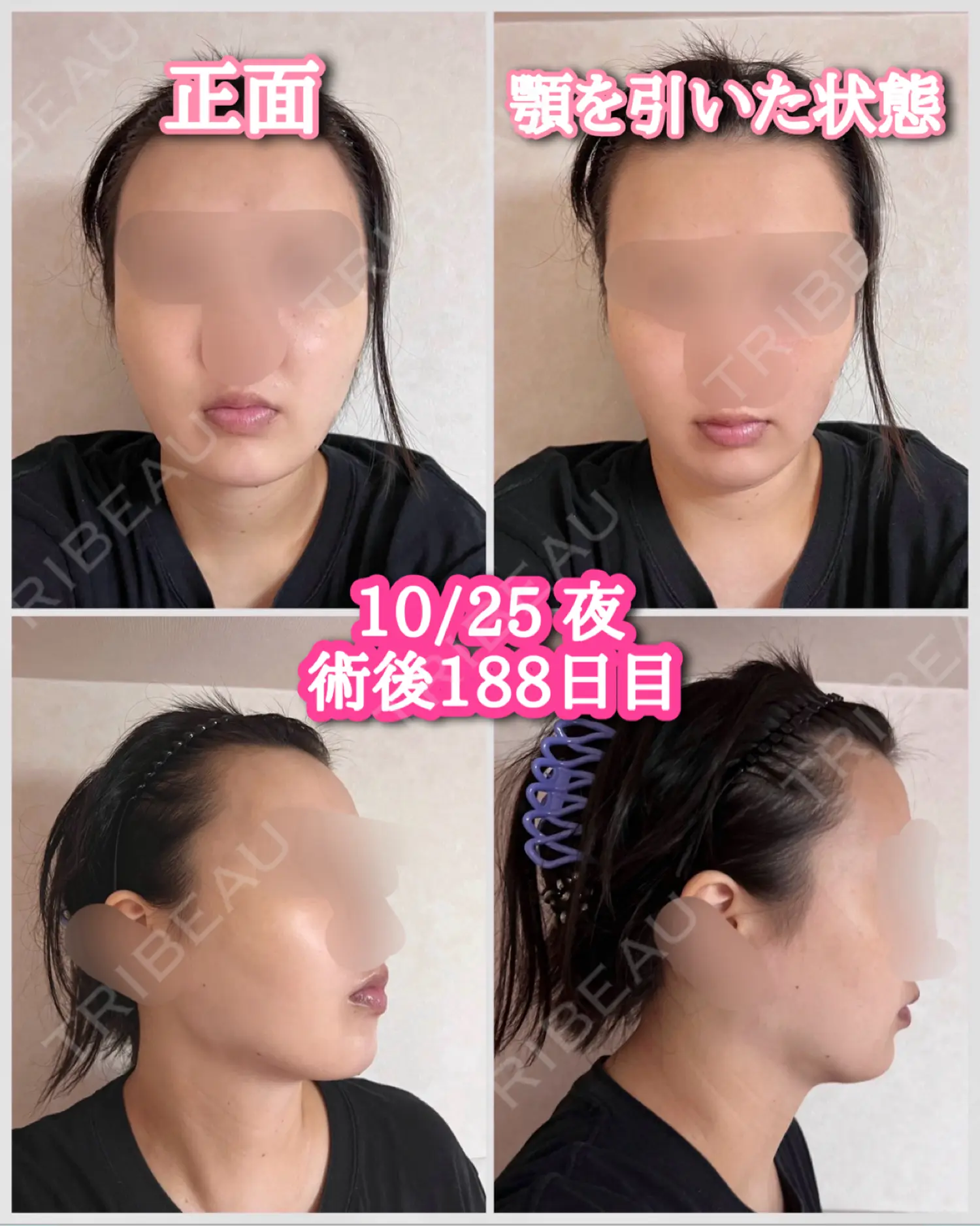 施術後の写真
