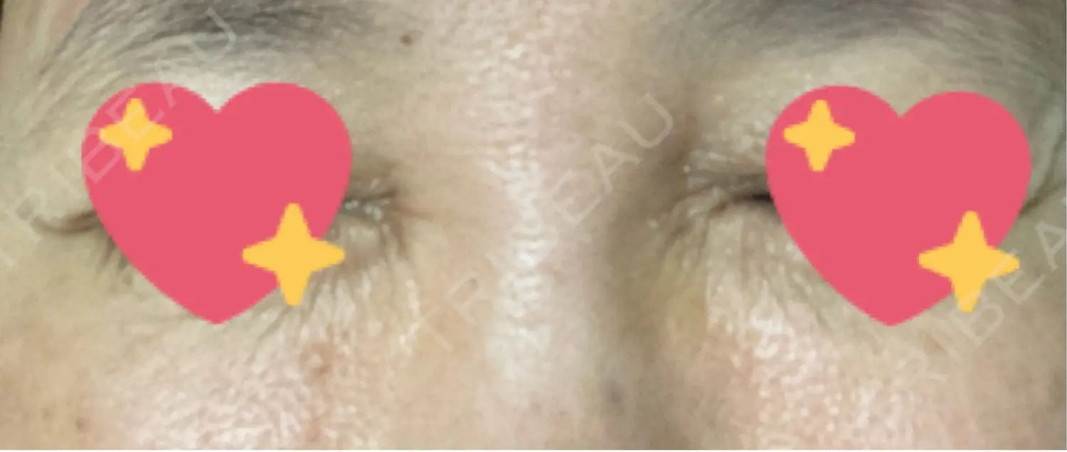 施術後の写真