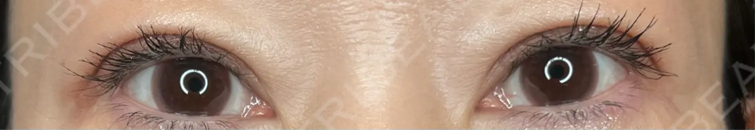 施術後の写真