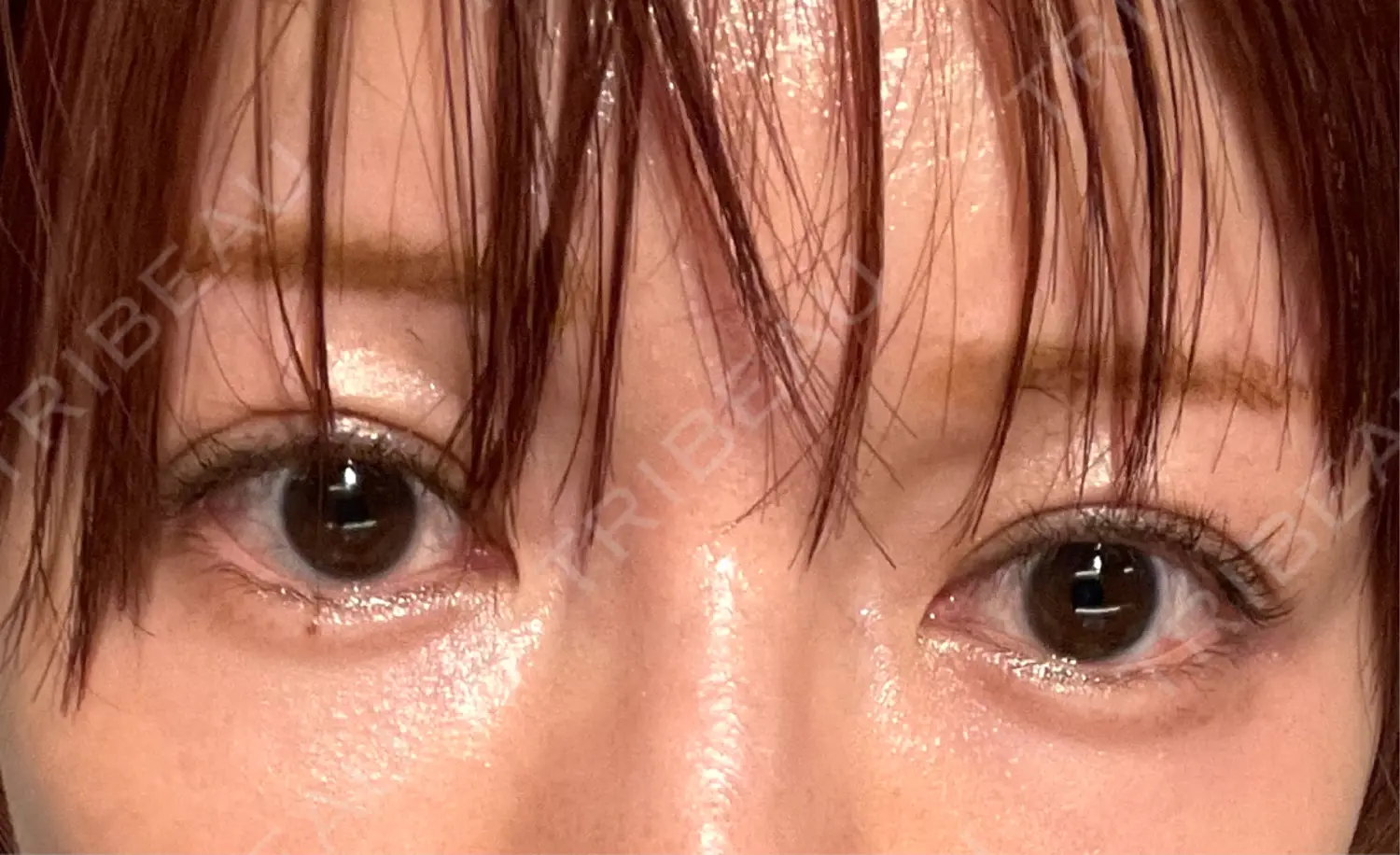 施術後の写真