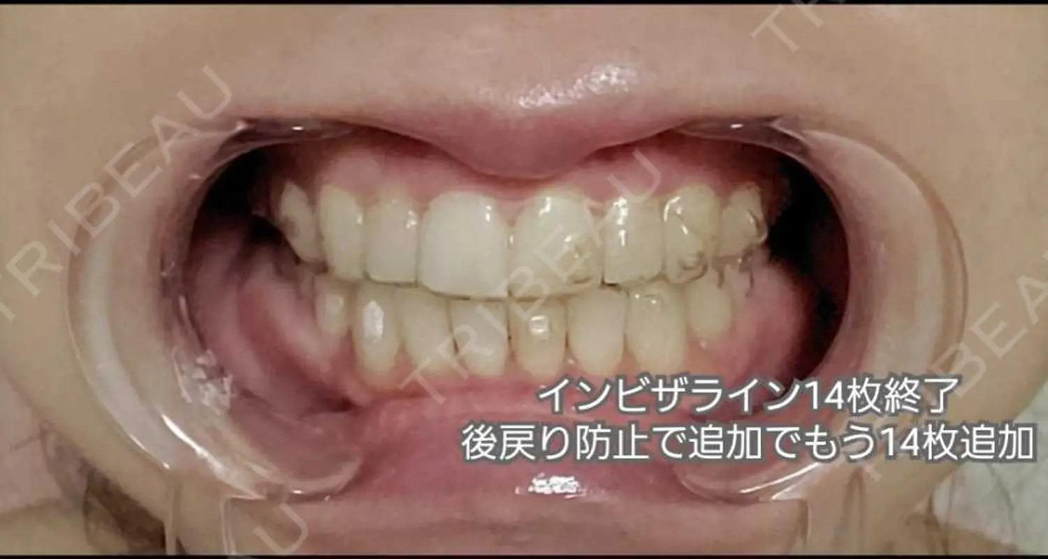 施術後の写真