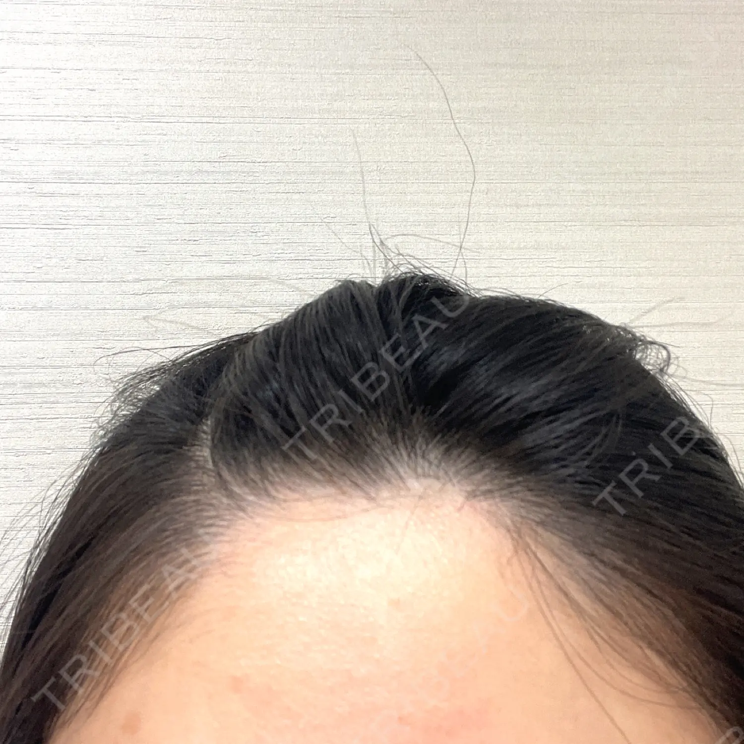 施術後の写真