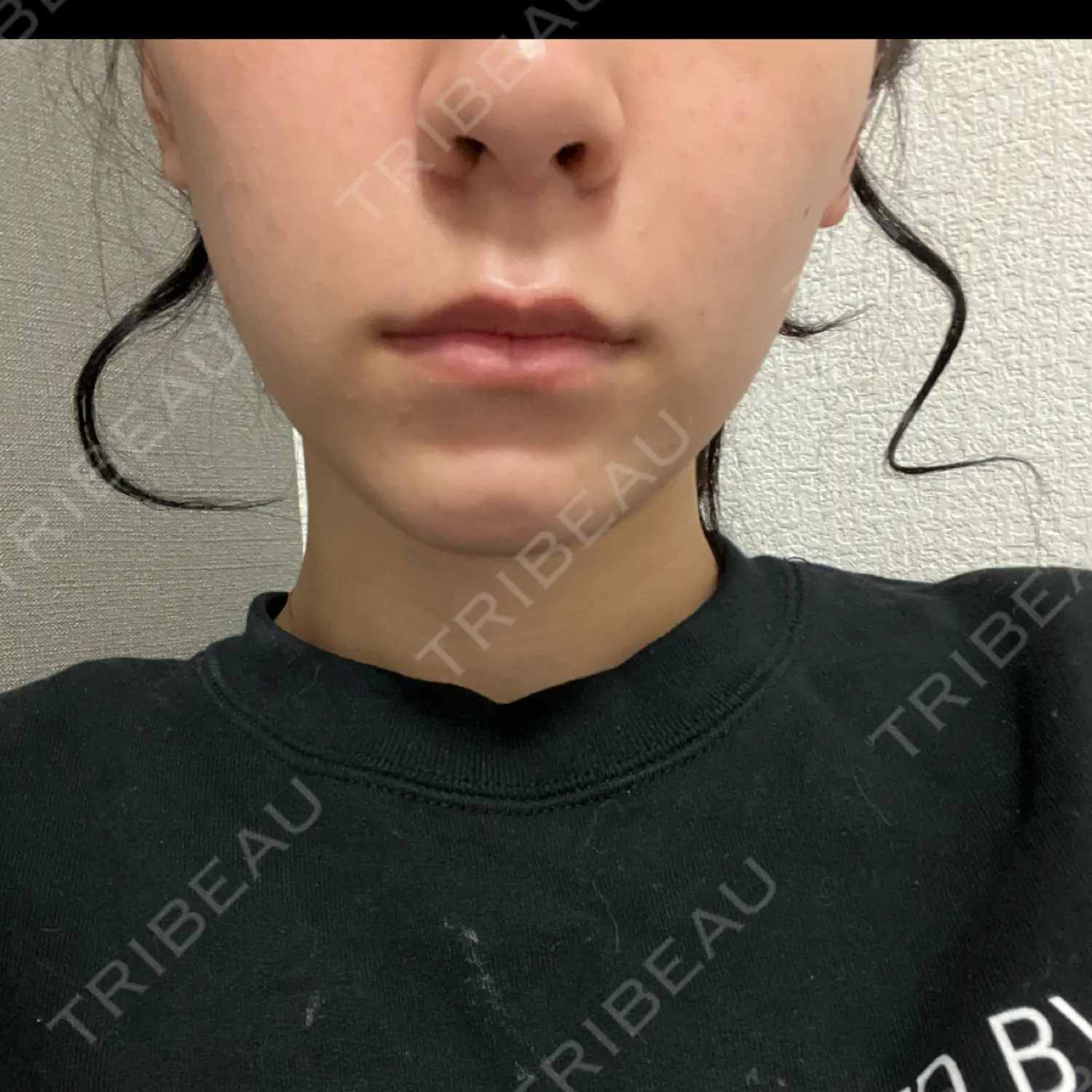 施術後の写真