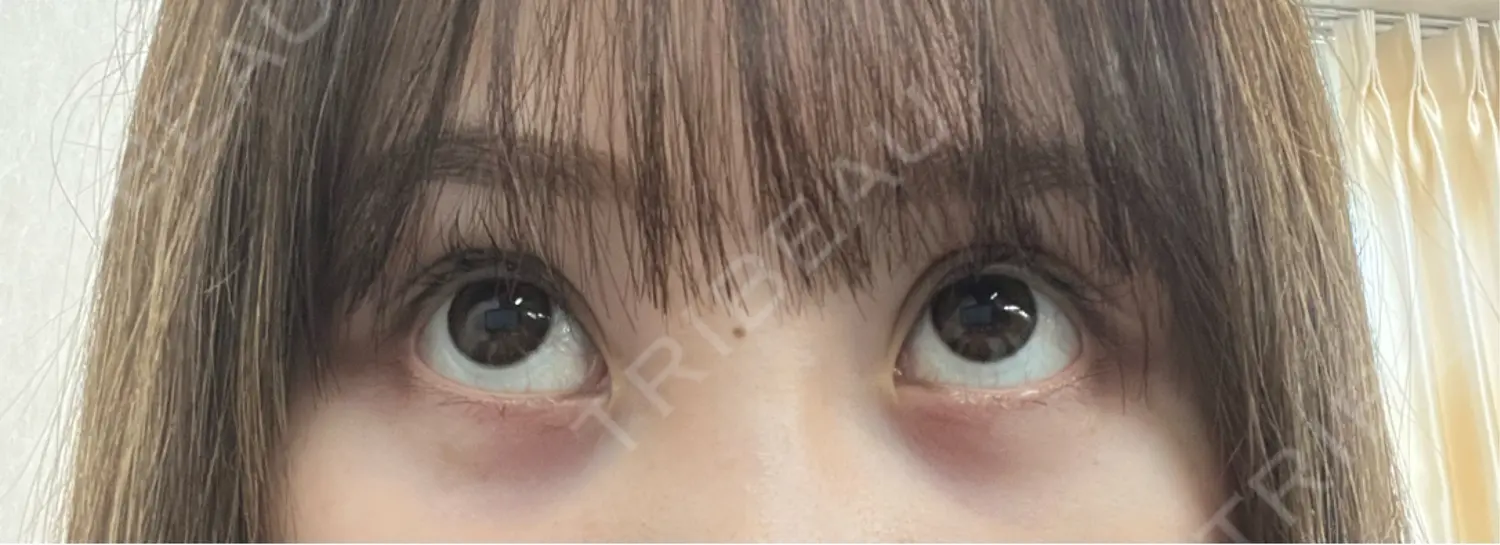 施術後の写真