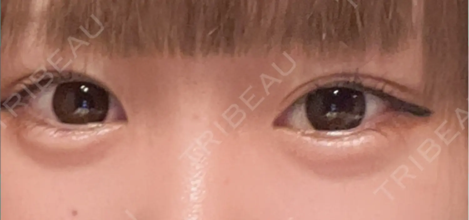 施術後の写真