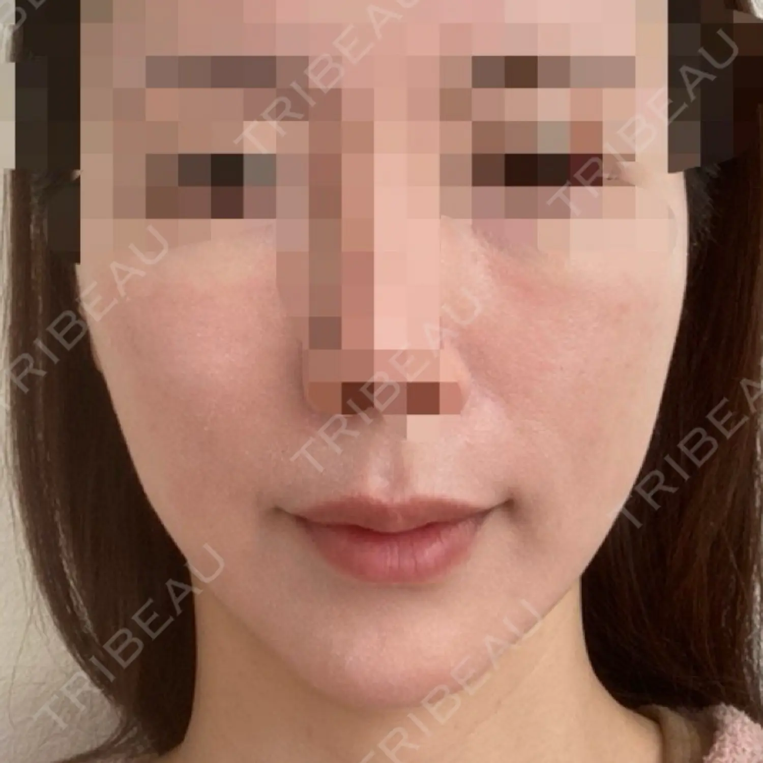 施術後の写真