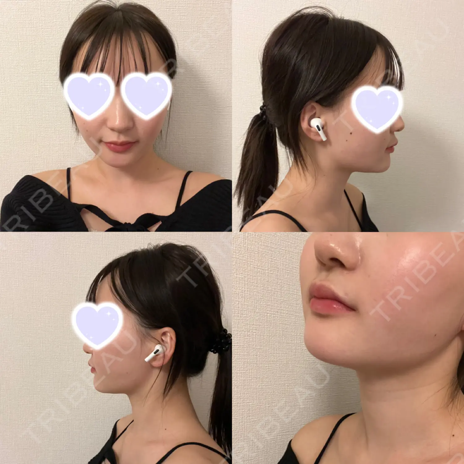 施術後の写真