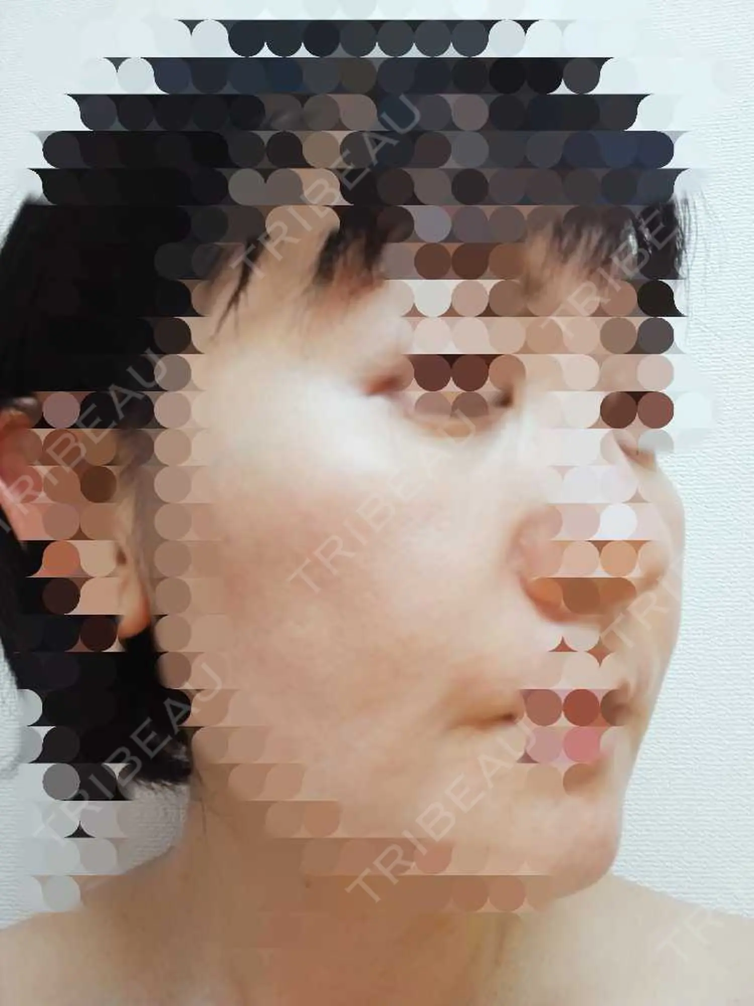 施術後の写真