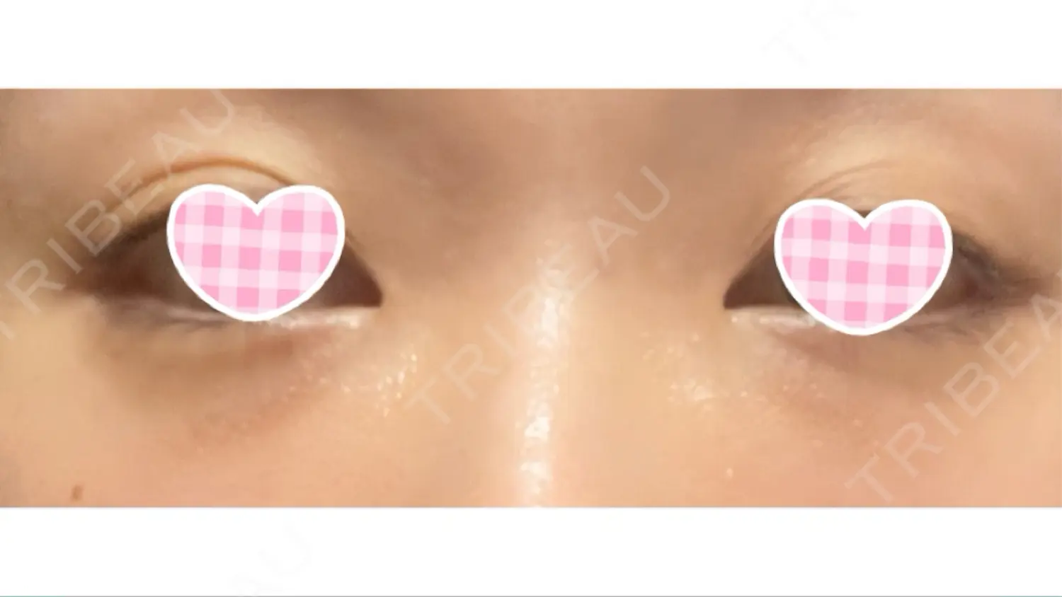 施術後の写真