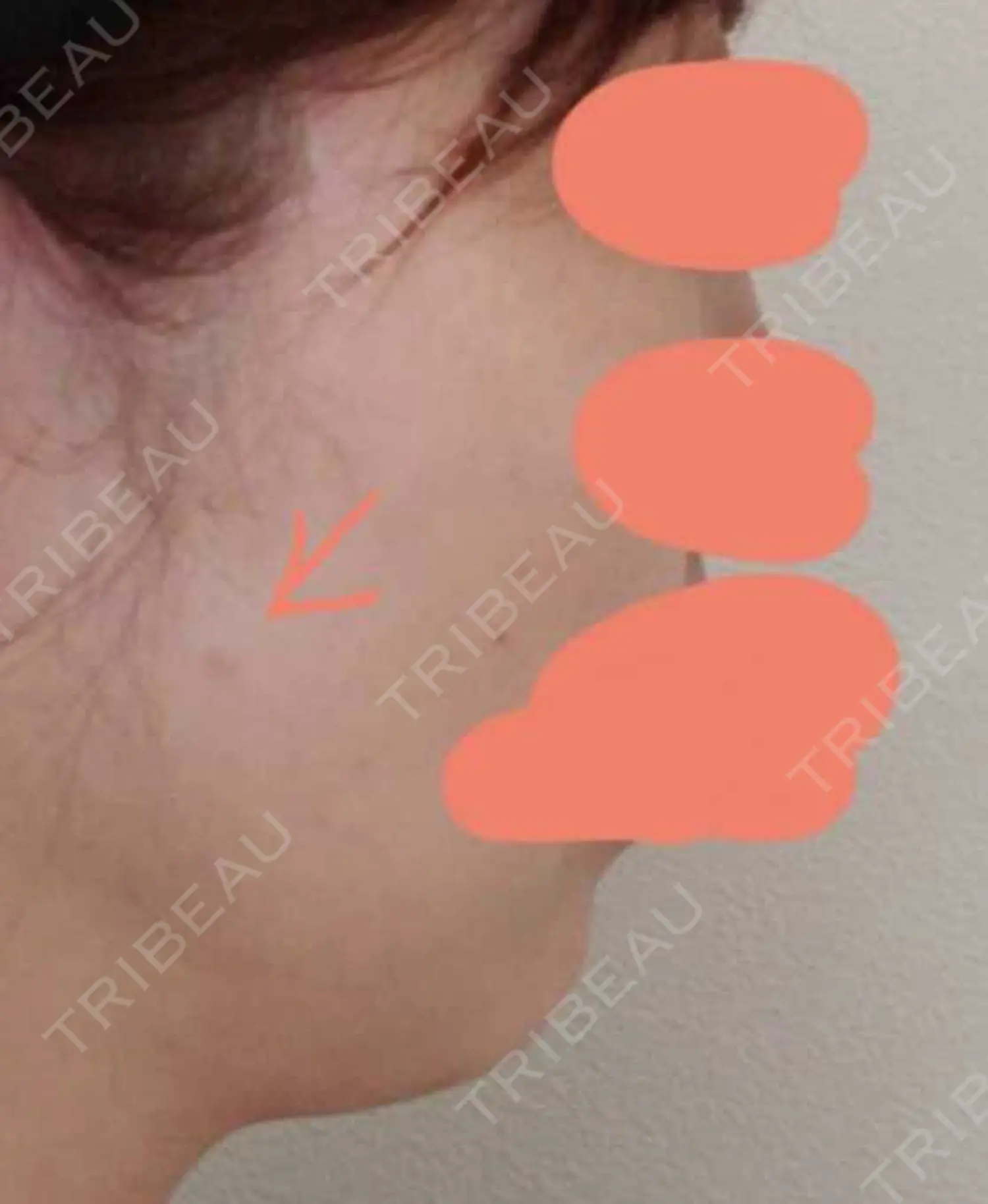 施術後の写真