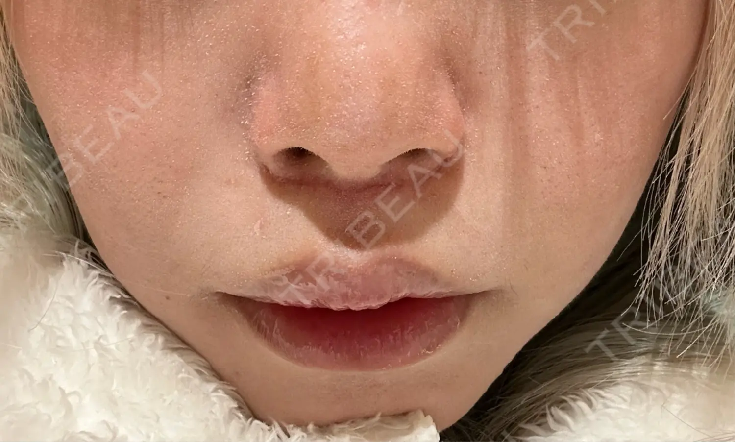 施術後の写真