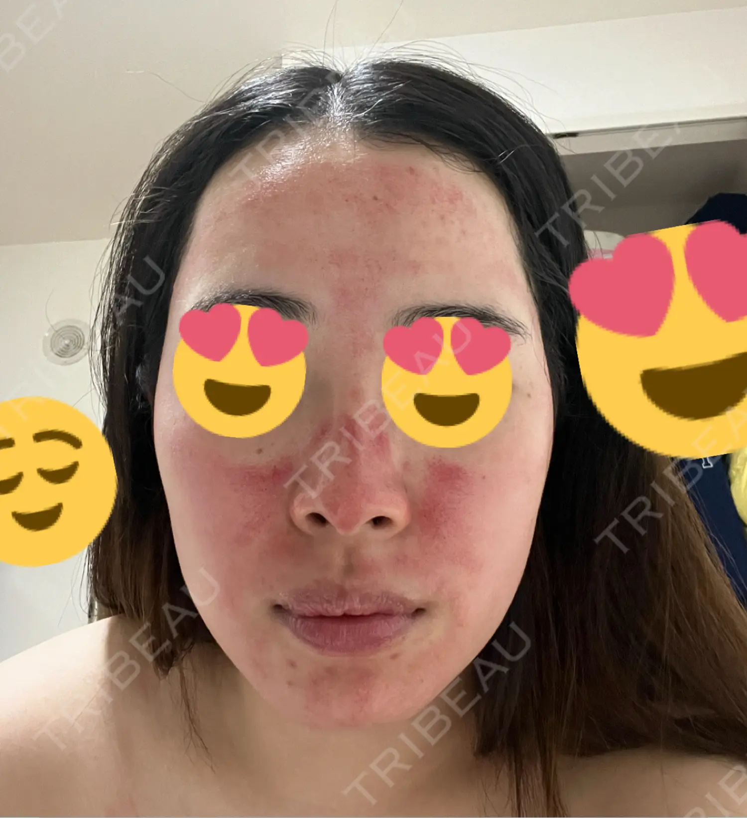 施術後の写真