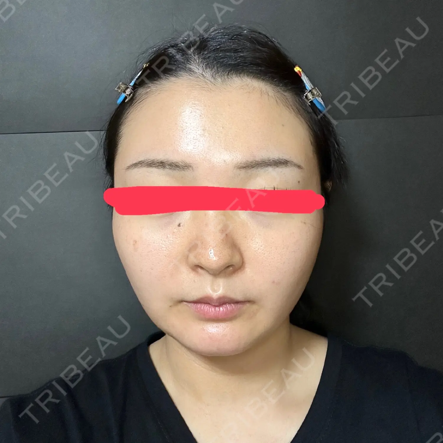 施術後の写真