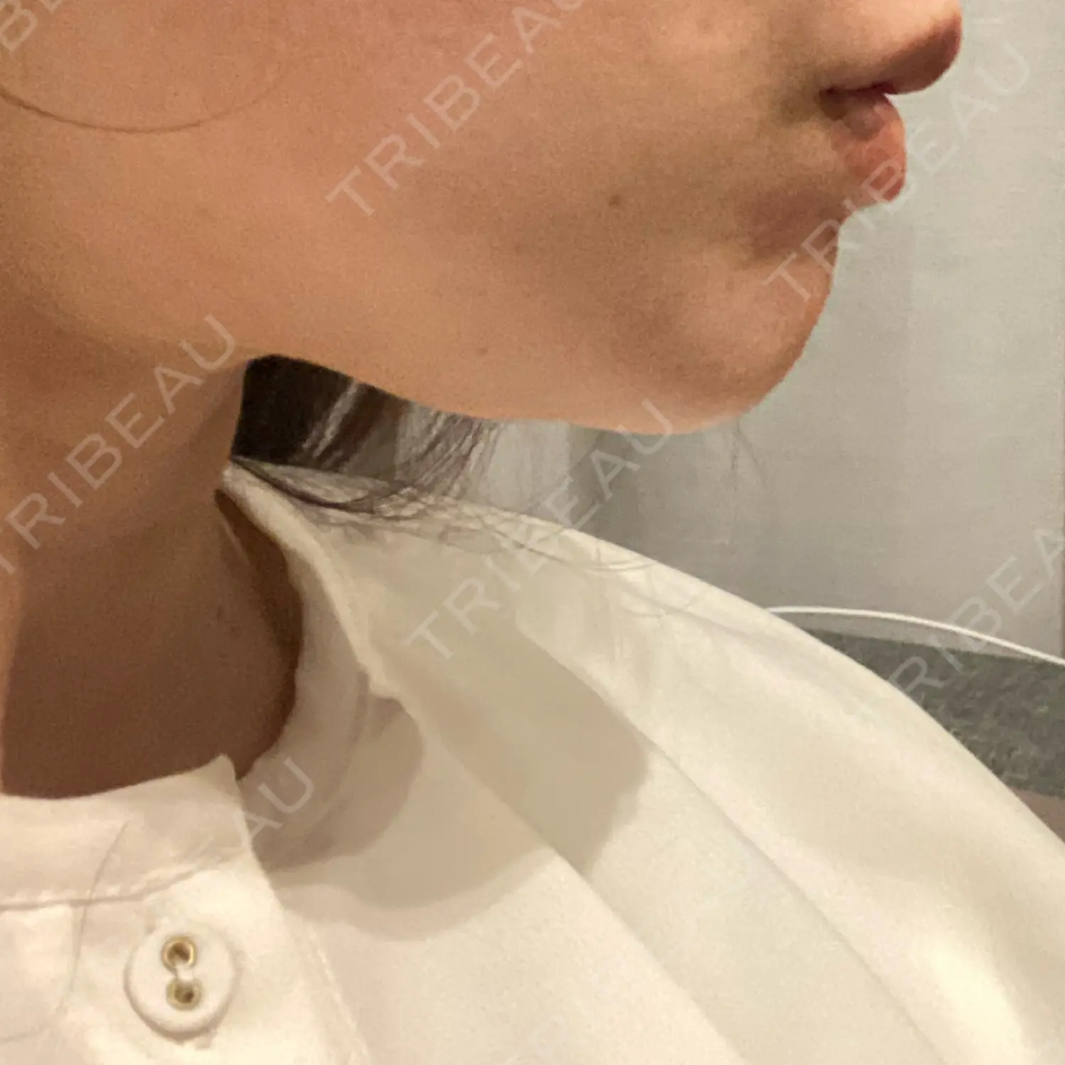 施術後の写真