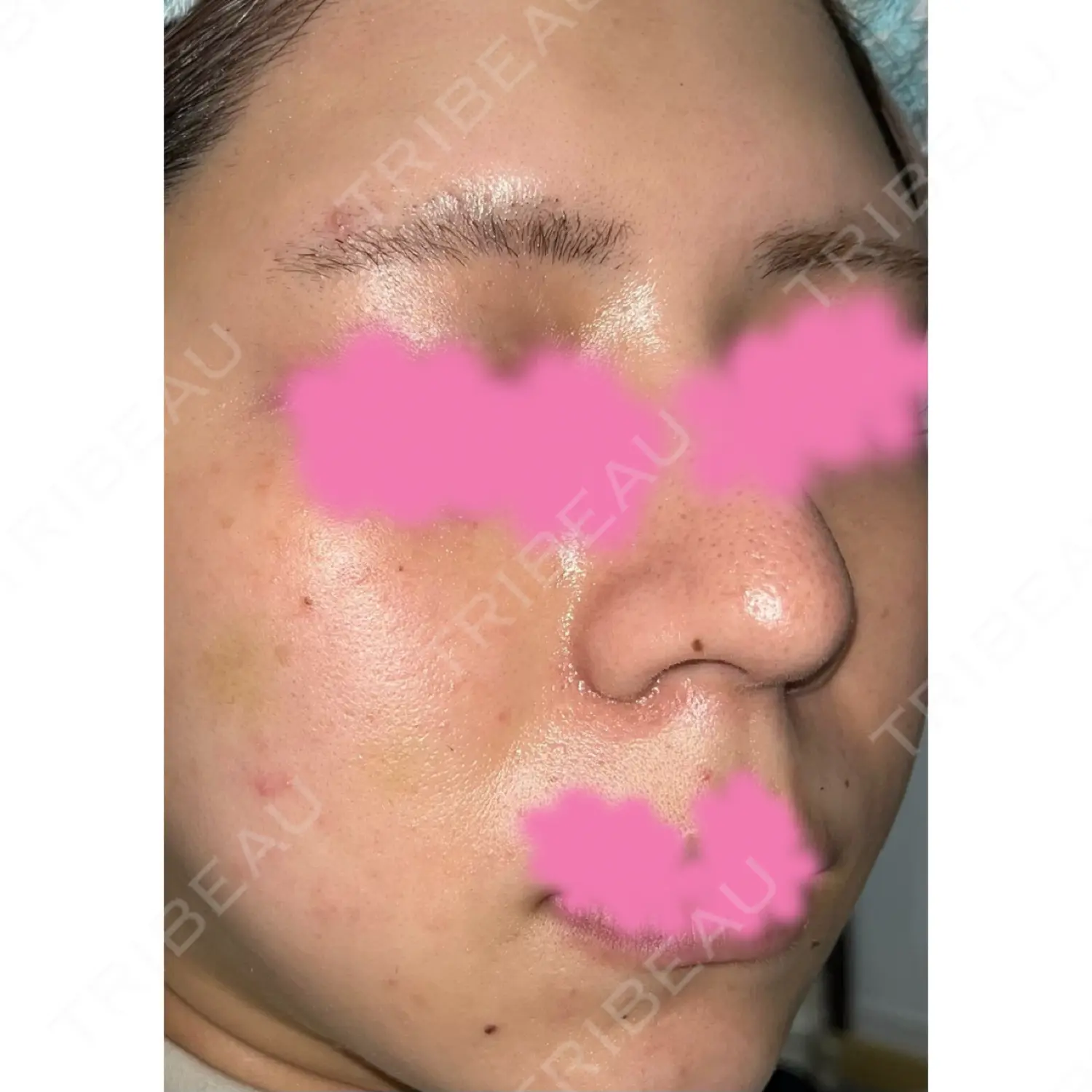 施術後の写真