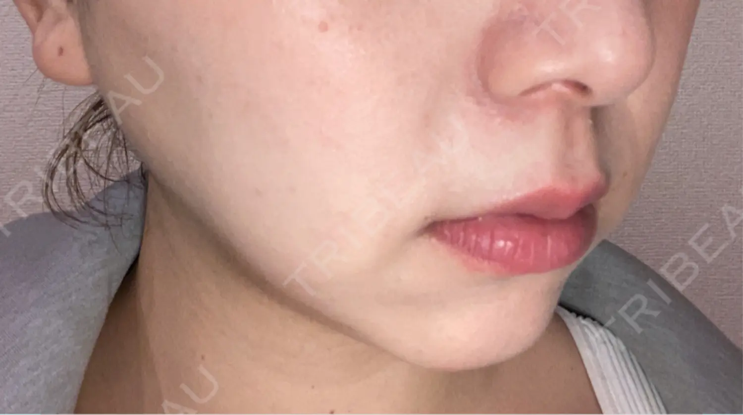 施術後の写真