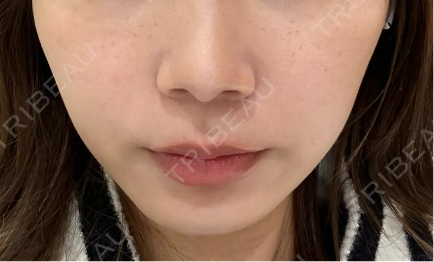施術後の写真