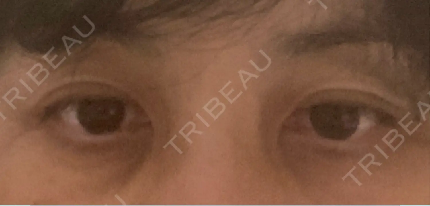 施術後の写真